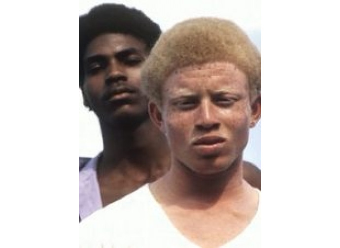 albino africa albino africa